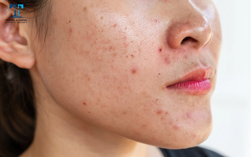 Da mẹ bầu vào mùa đông rất dễ kích ứng