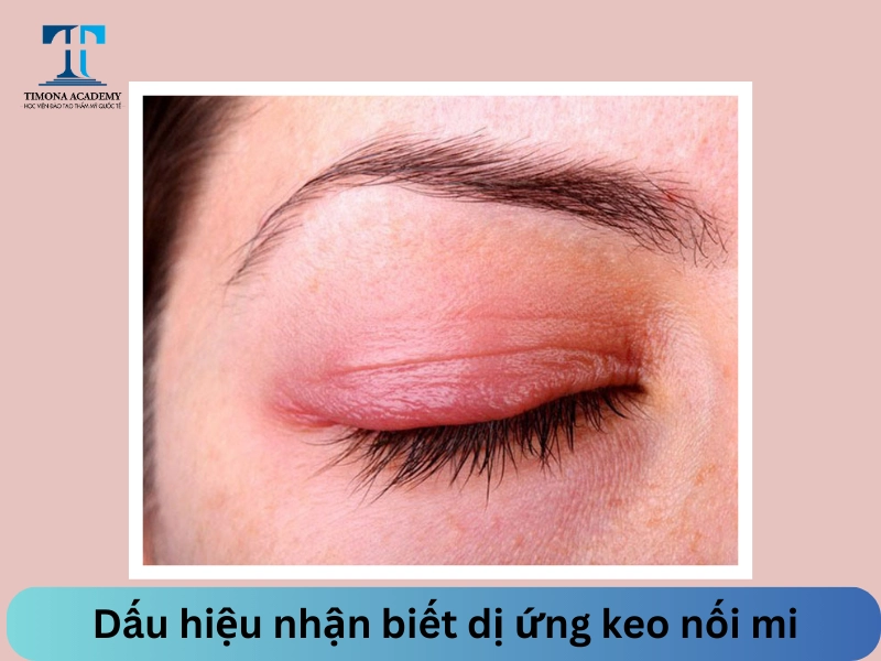 Dấu hiệu nhận biết dị ứng keo nối mi