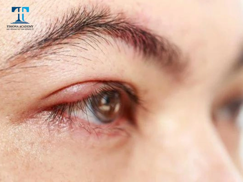 Dị ứng với mi giả cũng khiến mắt bạn bị sưng