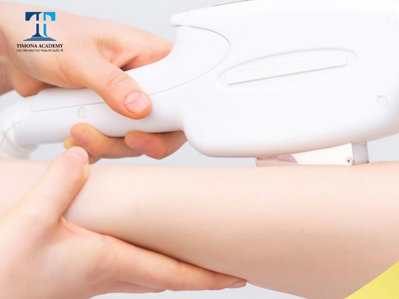 Trang bị máy triệt lông để cung cấp dịch vụ đa dạng