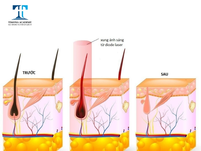 Triệt lông Diode Laser có nhiều ưu điểm