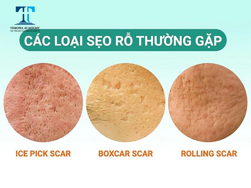 Cách phân loại các loại sẹo rỗ phổ biến
