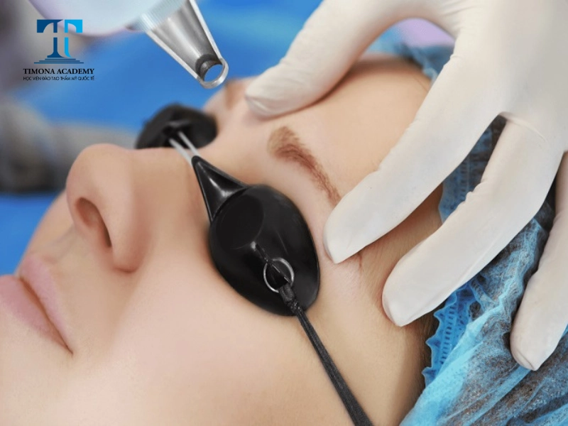 xử lý chân mày trổ xanh đỏ bằng công nghệ laser khá phổ biến