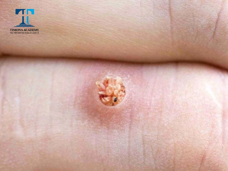 Mụn cóc có nhiều kích thước khác nhau