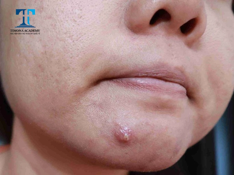 Mụn bọc thường mang đến cảm giác đau