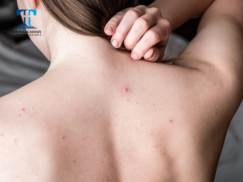 Mụn nhọt thường xuất ở cằm và lưng