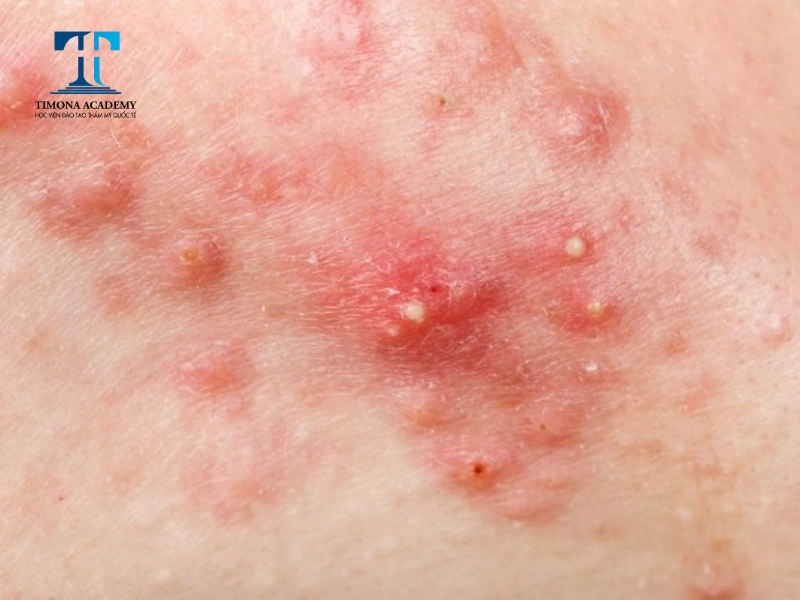 Mụn nang là tiến triển của mụn trứng cá nặng