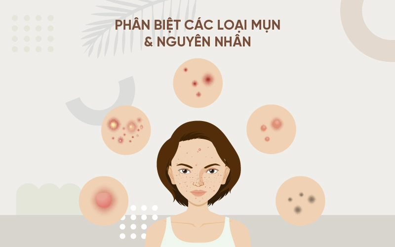 cách phân biệt các loại mụn trên mặt