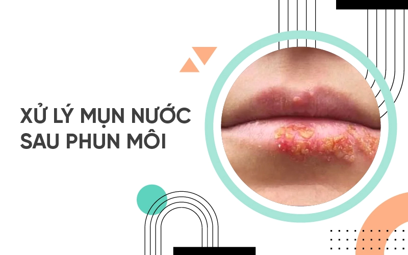 lên mụn nước sau phun môi