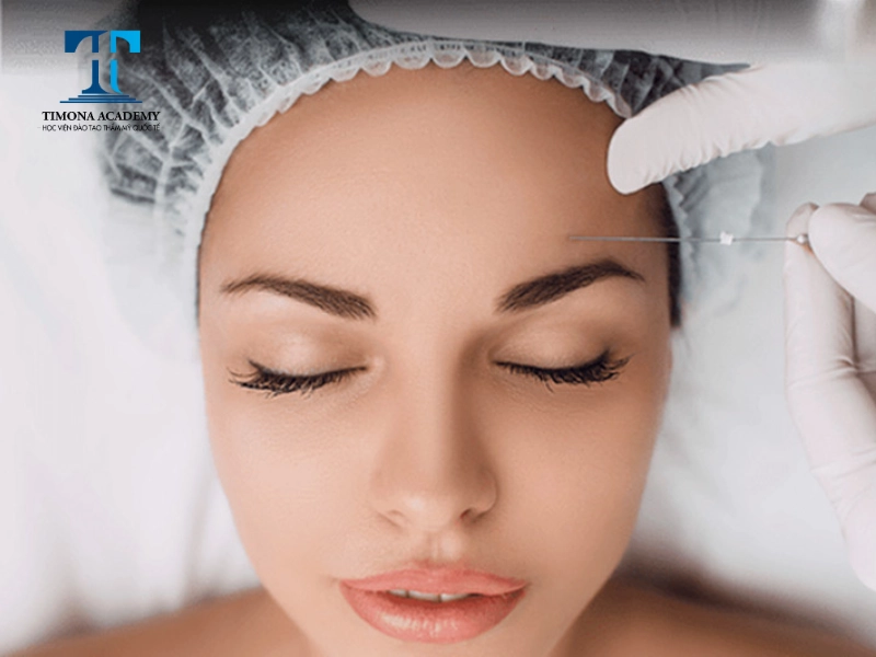 Nâng cung chân mày bằng chỉ không gây sẹo