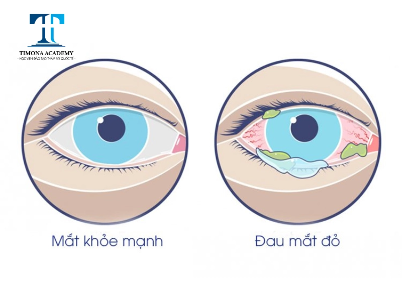 Đến gặp bác sĩ ngay nếu tình trạng mắt đỏ ngày một nghiêm trọng sau khi nối mi