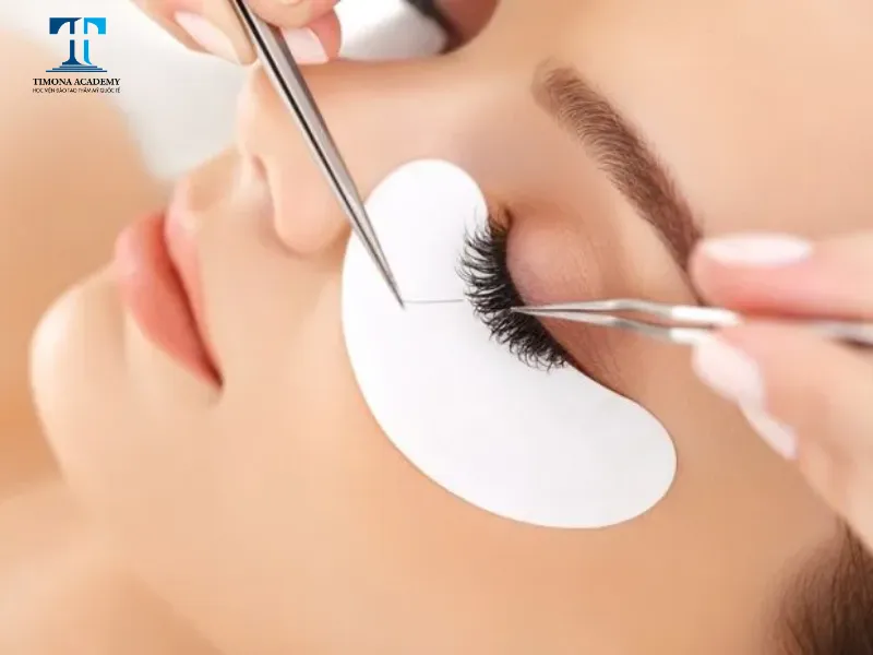Mi nối có thể sử dụng được từ 4 tuần - 6 tuần