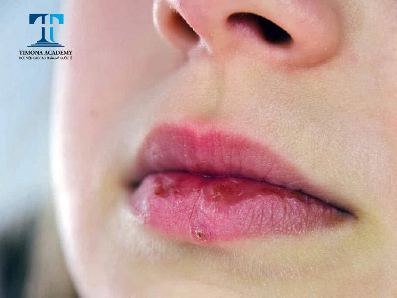 Môi không đủ ẩm dễ bị nứt da