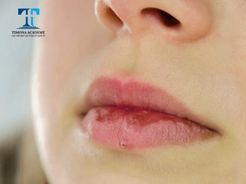 Môi bị nứt nẻ và không lên màu