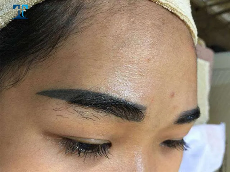 Kỹ thuật xăm chân mày truyền thống mực xăm sẽ đi trực tiếp vào lớp hạ bì của da