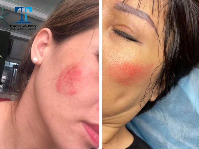 Má hồng hỏng rất khó để khắc phục