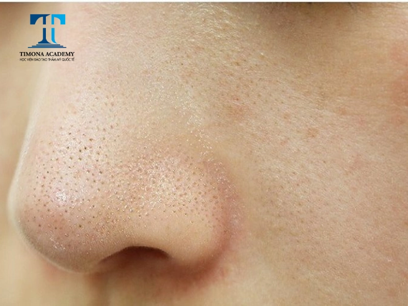 Mụn cám xuất hiện nhiều ở mũi gây mất thẩm mỹ