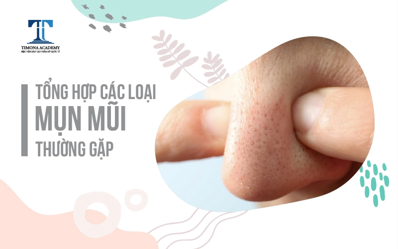 các loại mụn ở mũi