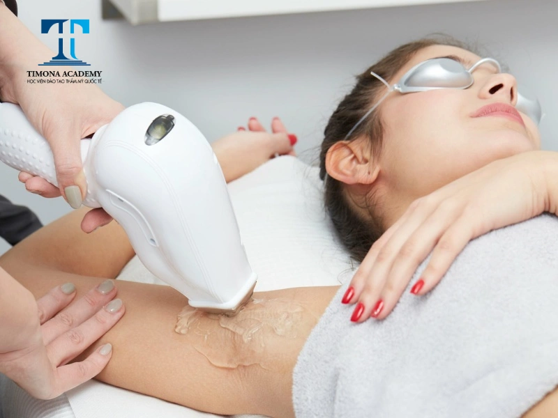 Quy trình triệt lông bằng Diode Laser