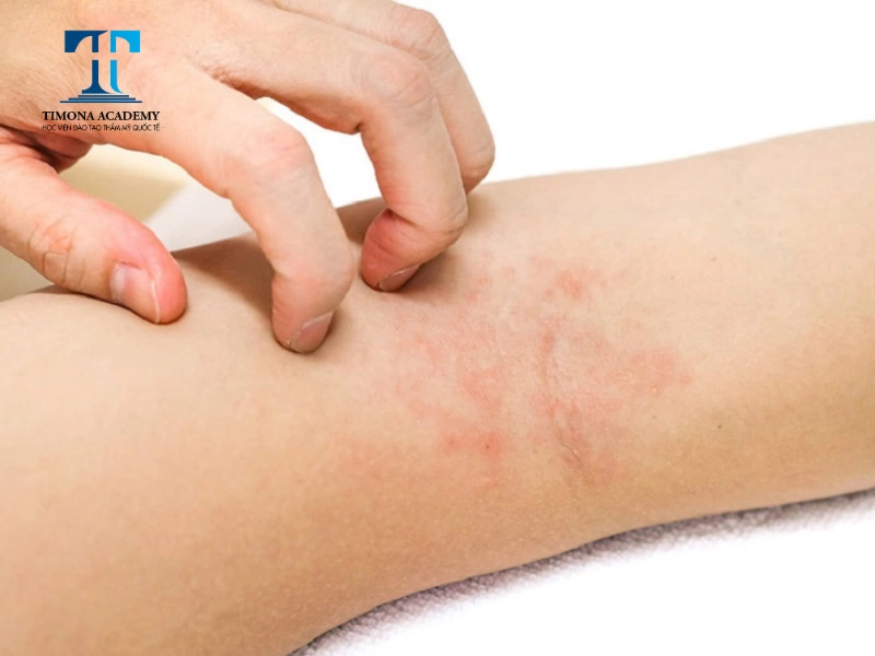 Nổi mẩn đỏ là tác dụng phụ thường gặp khi triệt lông bằng Diode Laser
