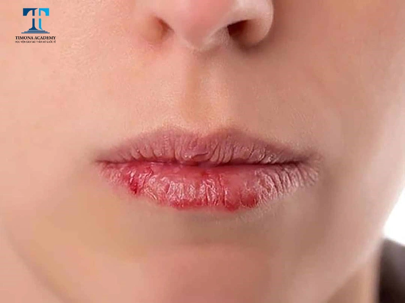 Ăn mực sau phun xăm có thể gây ra lở loét môi