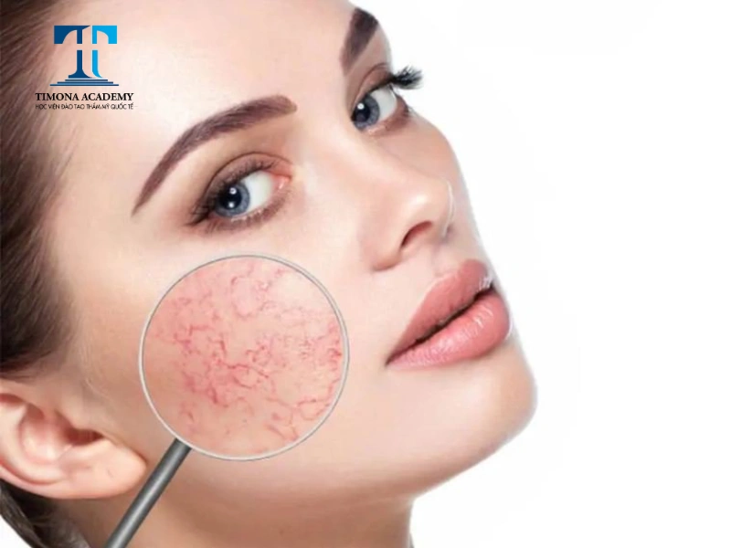 Da mỏng có lớp da phần hạ bì không dày như bình thường