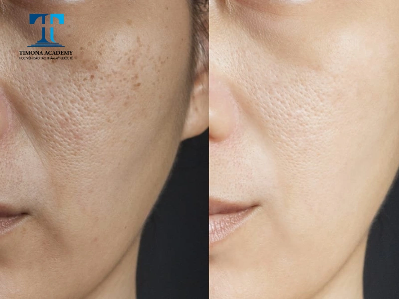 Ưu điểm nổi bật của peel da giúp cải thiện tình trạng nám da hiệu quả