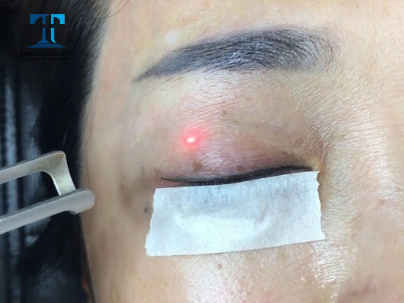 Xóa bỏ mực phun mí cũ bị trổ xanh bằng laser