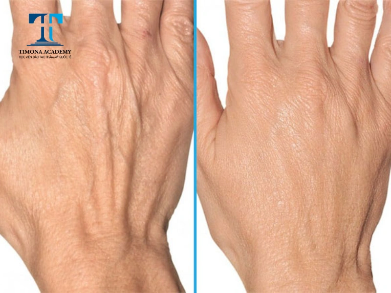 Phương pháp Trẻ hóa da tay bằng công nghệ Laser đang rất được chị em ưa chuộng