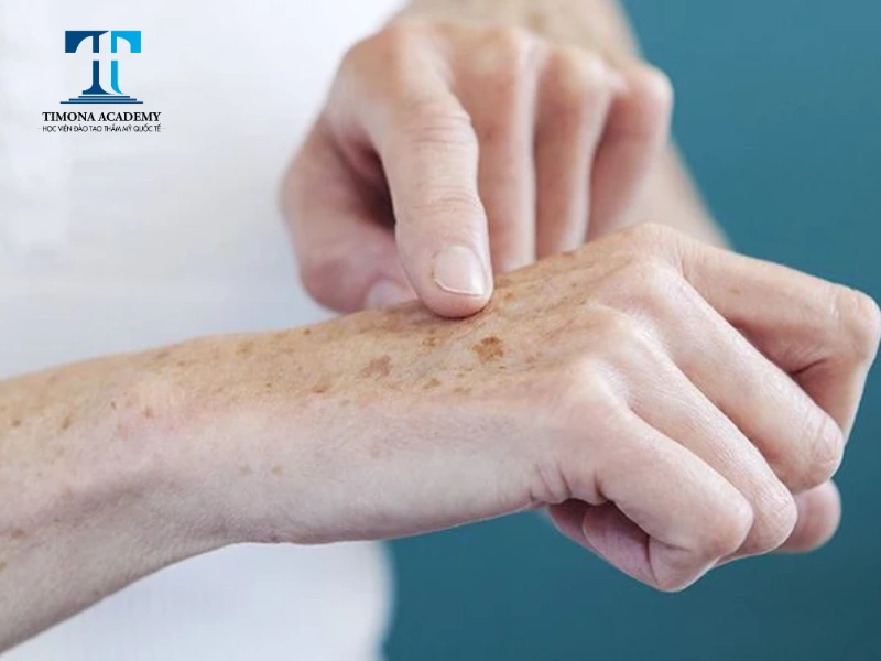 Nổi đồi mồi và đốm nâu là hai dấu hiệu da tay lão hóa phổ biến nhất