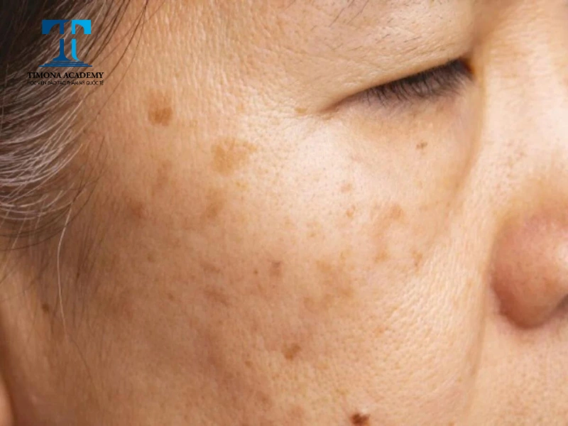 laser có thể loại bỏ được đồi mồi