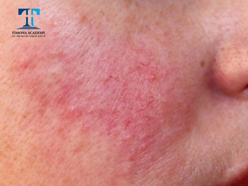 điều trị laser bị đỏ rát khó chịu