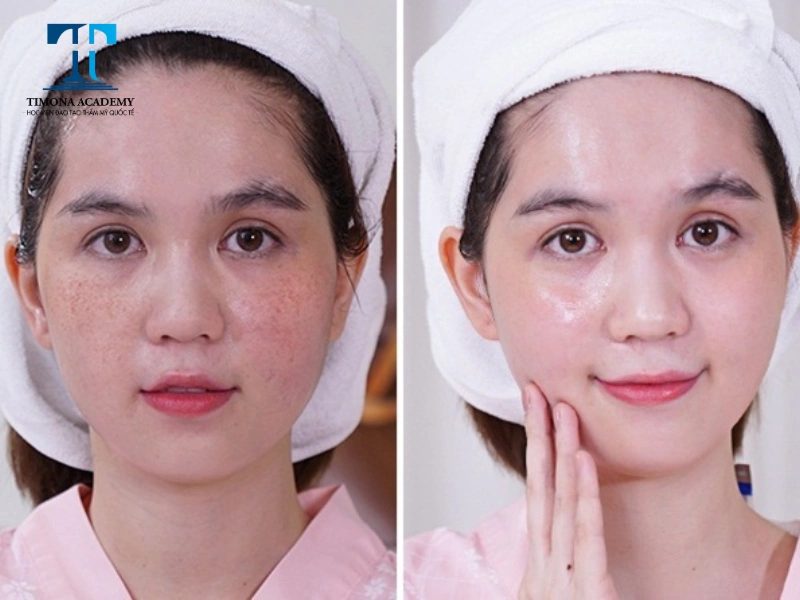 Bắn laser trị nám phù hợp với những người gặp tình trạng nám, tàn nhang và đốm nâu trên da