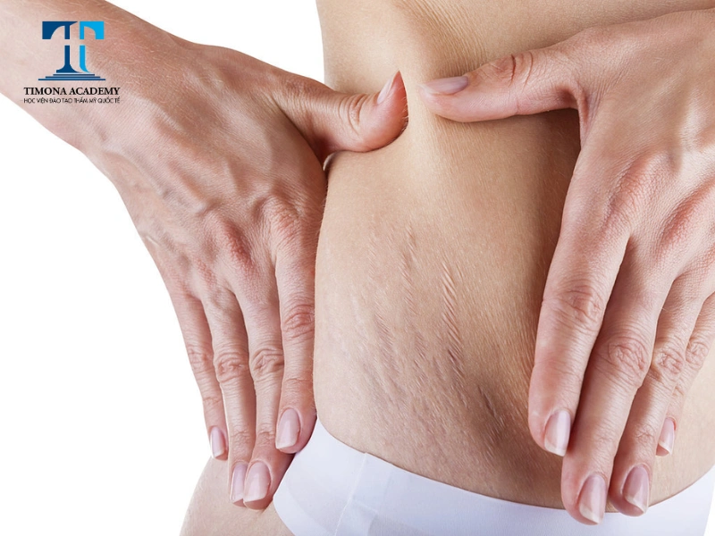 Phần lớn phụ nữ sau khi sinh đều bị rạn da