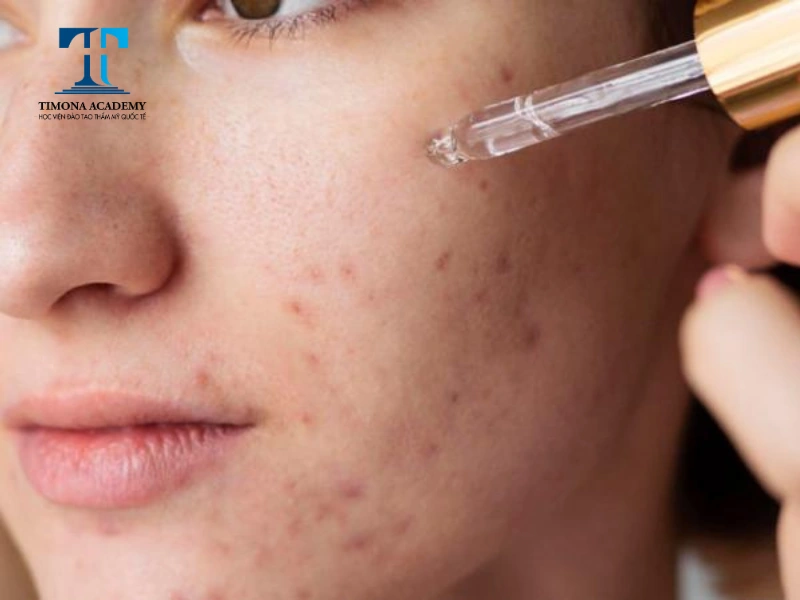 Không được sử dụng retinol sau khi bắn laser