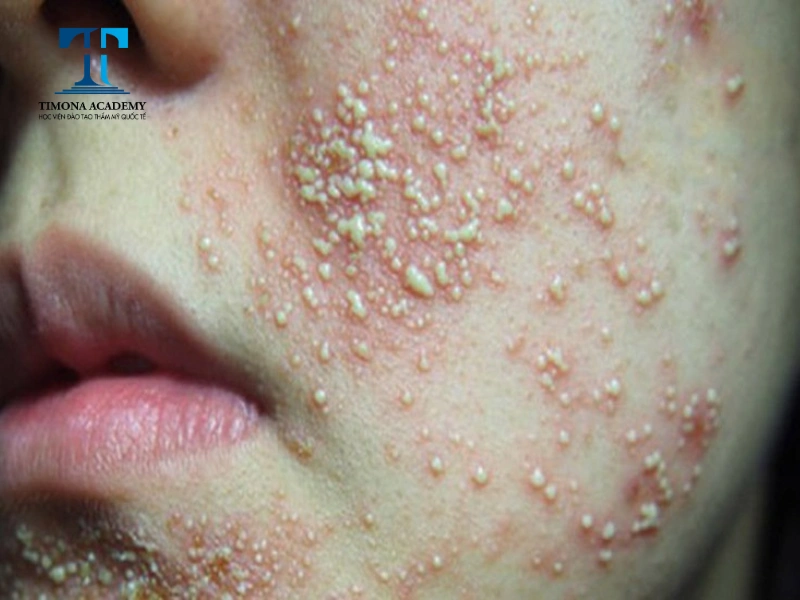 trường hợp nhiễm corticoid nặng có biểu hiện da bị lở loét