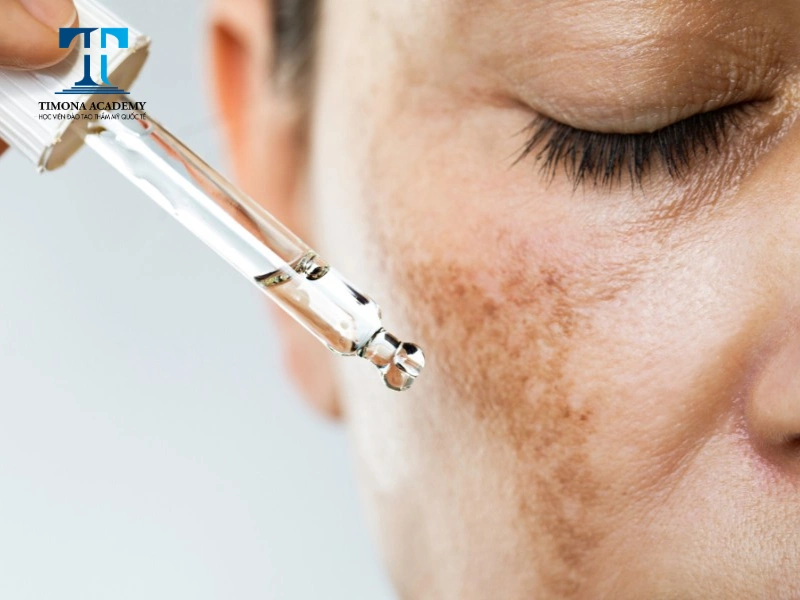 bị tàn nhang có thể áp dụng công nghệ làm đẹp da bằng tế bào gốc