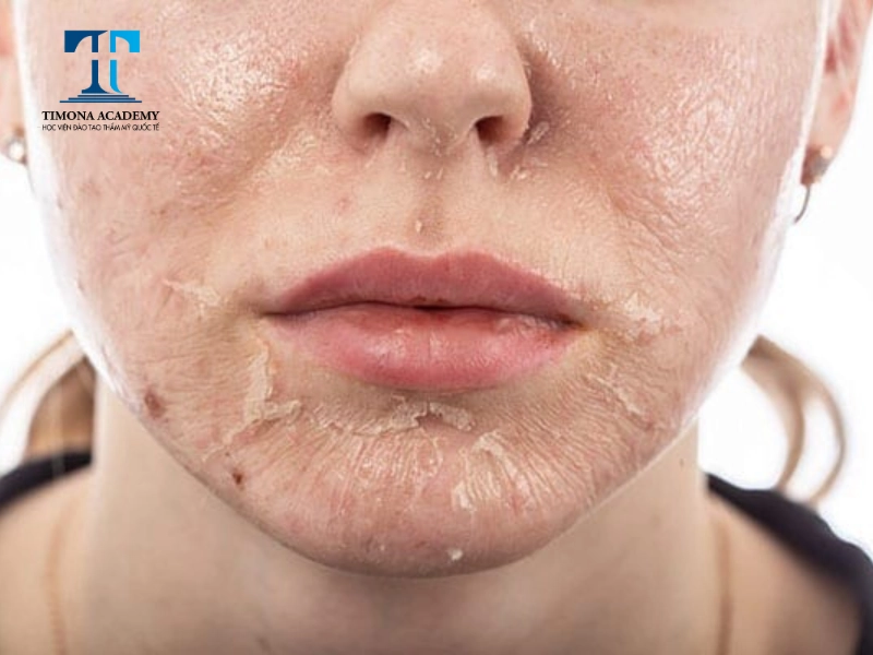 Đẩy nhanh quá trình hồi phục nên sử dụng Niacinamide