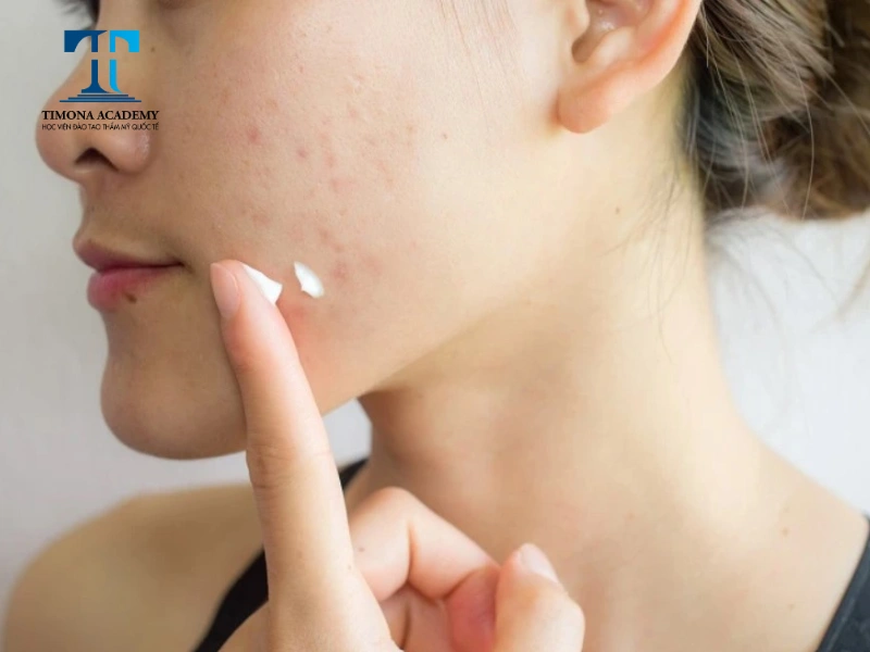 Axit Salicylic peel da có thể loại bỏ đốm tàn nhang trên da