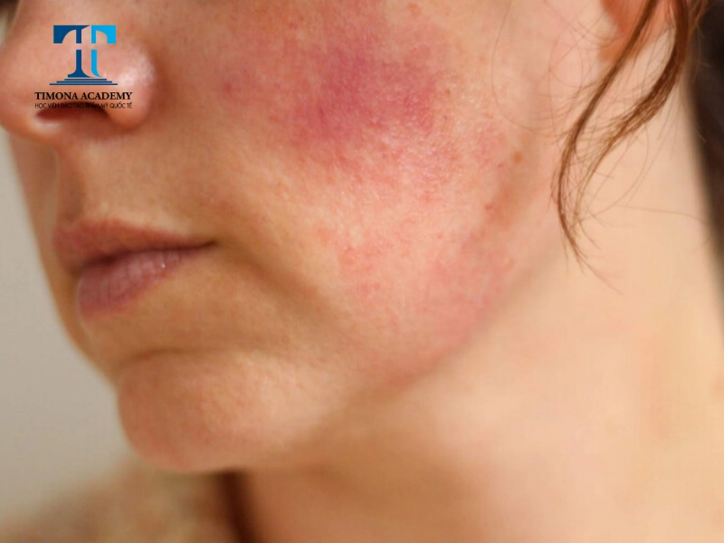 Phi kim tế bào gốc có thể gây kích ứng đối với làn da nhạy cảm