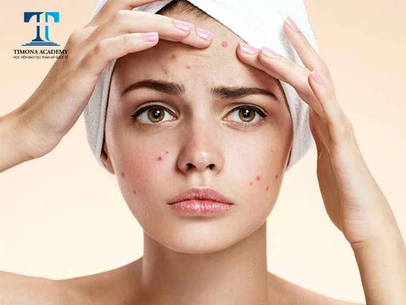 Cần áp dụng đúng quy trình chăm sóc da mụn ẩn để mang lại hiệu quả tối ưu