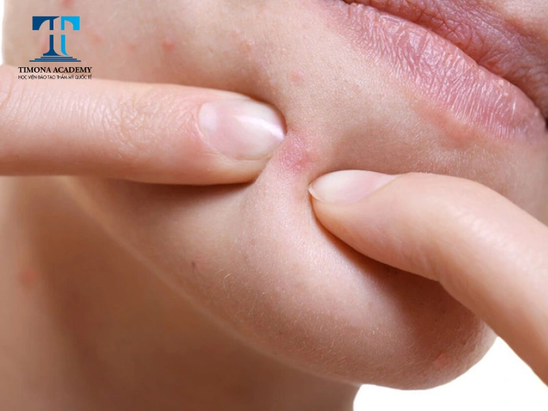 Không tự ý nặn mụn ẩn khi không nắm vững kỹ thuật chuyên môn