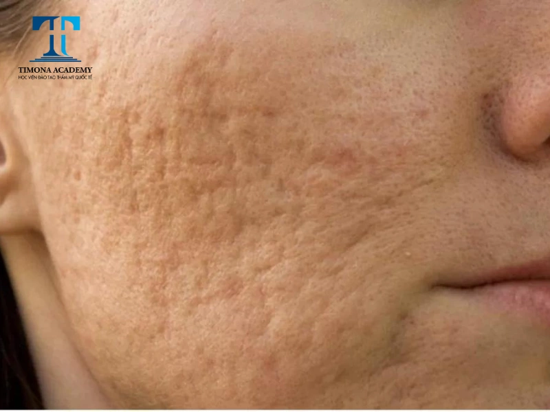 Vị trí xuất hiện của sẹo rỗ đáy nhọn thường là hai bên má