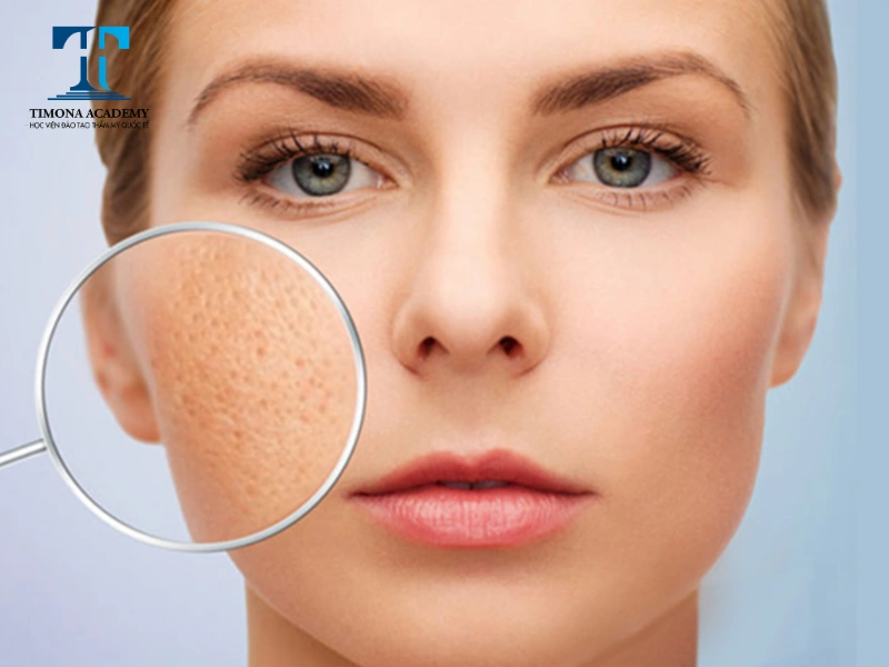 Cách trị sẹo đáy nhọn tại nhà hiệu quả là dùng kem trị sẹo