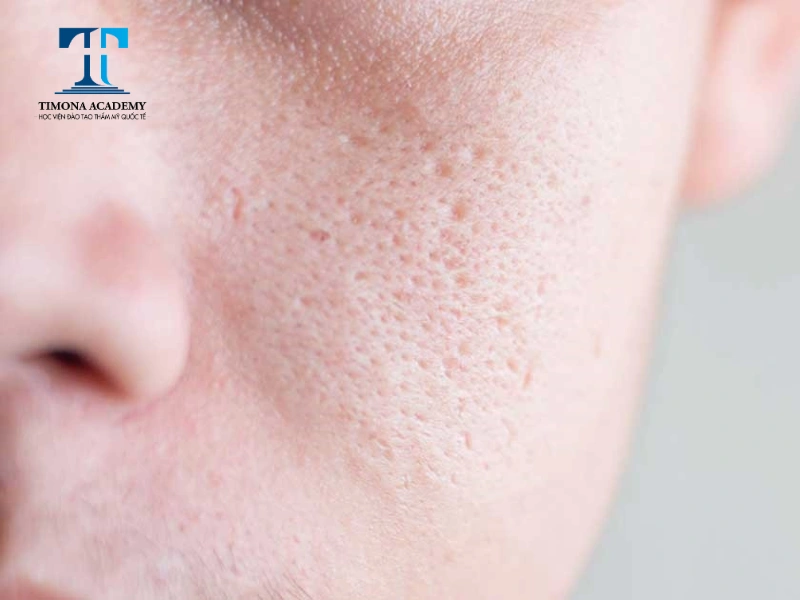 Mụn trứng cá điều trị không đúng cách có thể gây nên sẹo rỗ trên mặt