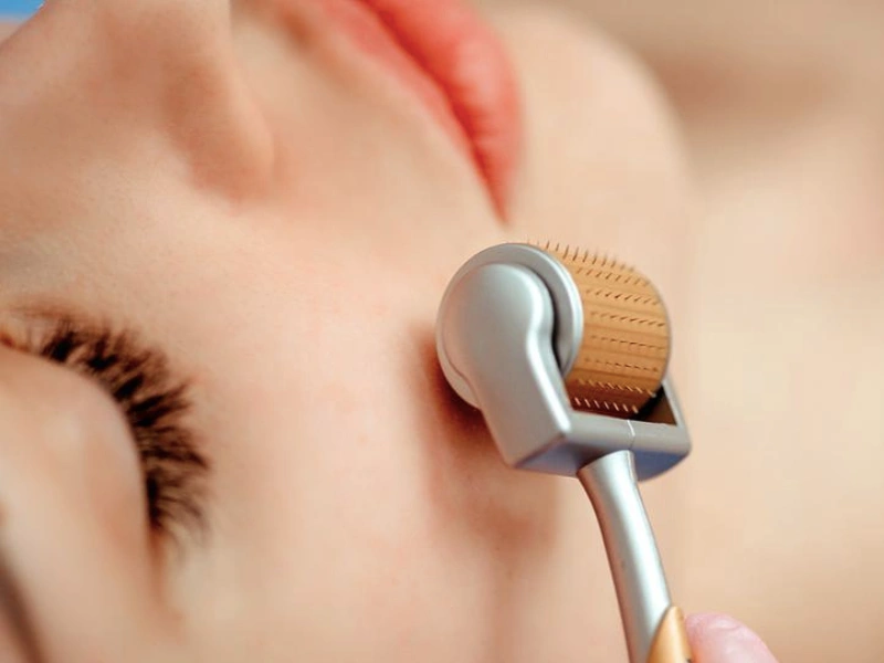 Phương pháp lăn kim điều trị sẹo rỗ mang lại hiệu quả cao
