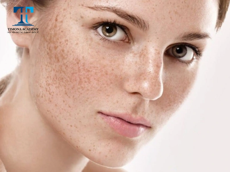 Skincare có thể giúp phòng ngừa nám và tàn nhang hiệu quả