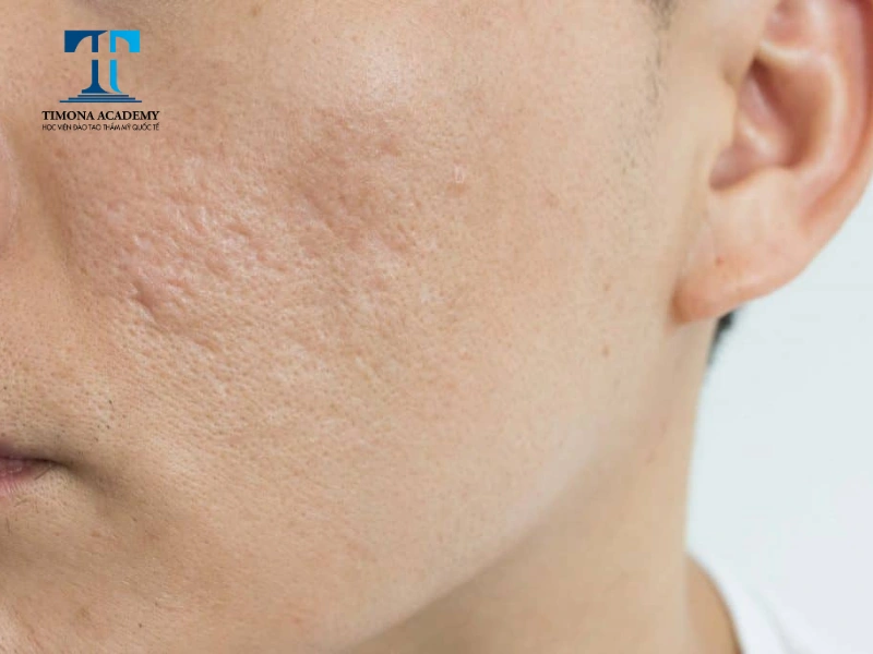Chăm sóc da bị sẹo rỗ đúng cách để ngăn ngừa sẹo nặng