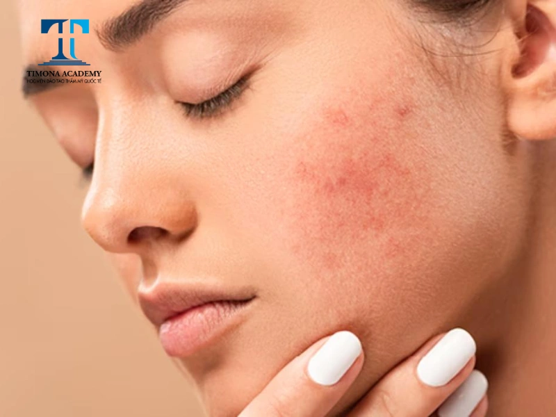Da bị kích ứng gây khó chịu