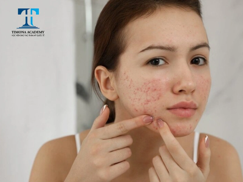 Nổi mụn là biểu hiện thường gặp nhất khi da bị kích ứng 